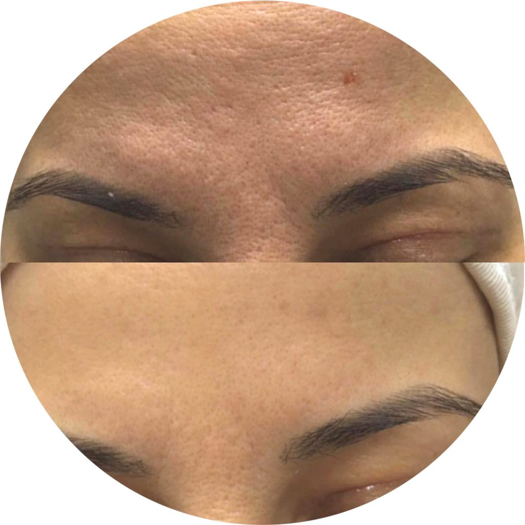 DermaRoller Before & After Results | DermaRoller SA®