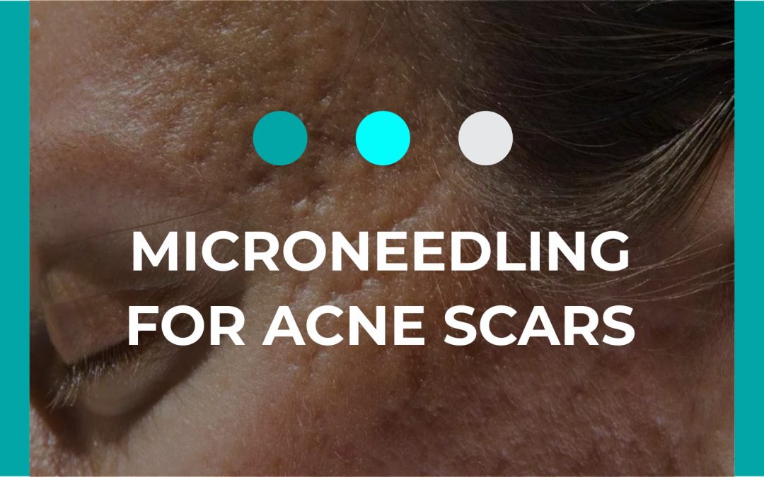 Is Microneedling Effective for Acne Scars?