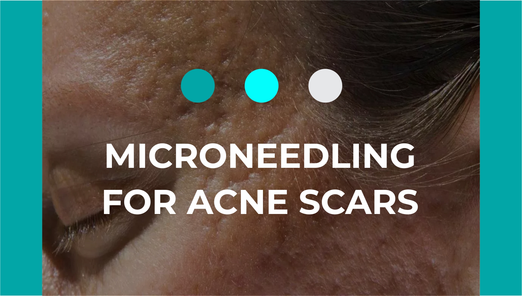Is Microneedling Effective for Acne Scars?