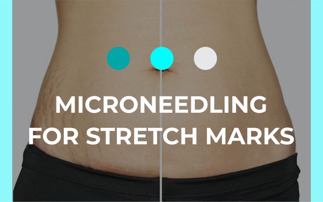 Are DermaRollers Effective for Stretch Marks?