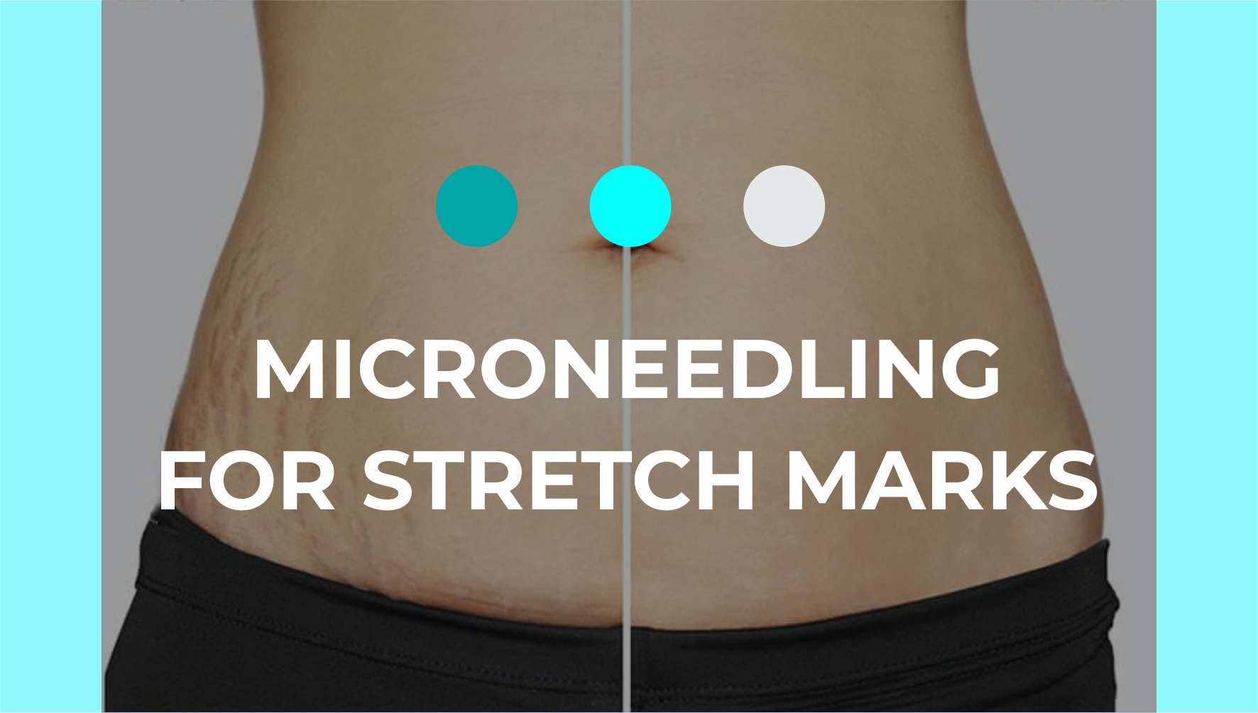 Microneedling For Stretch Marks